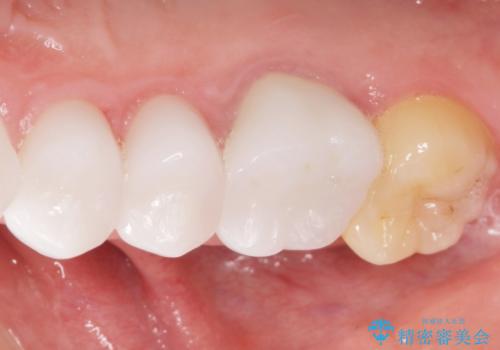 歯並びをきれいにしたい、歯を真っ白にしたい 40代男性の治療後