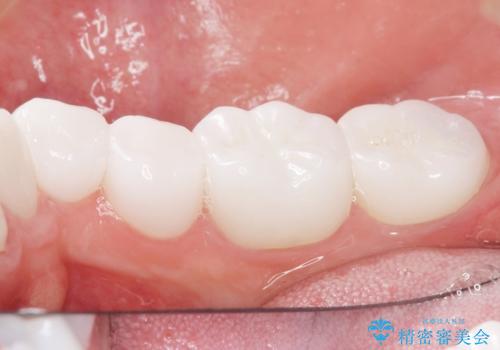 歯並びをきれいにしたい、歯を真っ白にしたい 40代男性の治療後