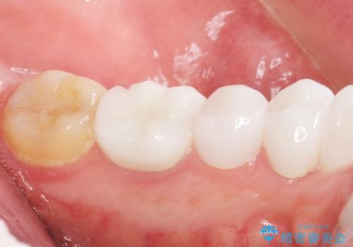 歯並びをきれいにしたい、歯を真っ白にしたい 40代男性の治療後