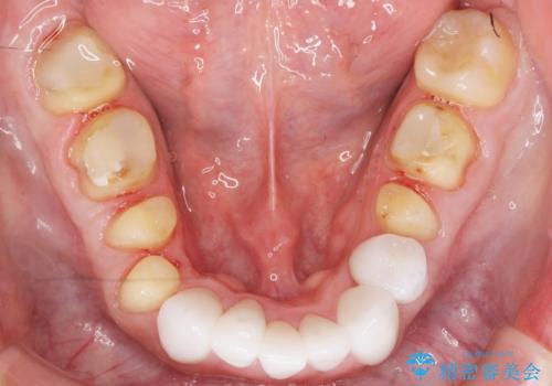 歯並びをきれいにしたい、歯を真っ白にしたい 40代男性の治療中