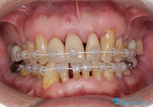 矯正治療と歯周外科処置を併用した審美歯科治療の治療中