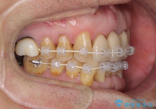 矯正治療と歯周外科処置を併用した審美歯科治療の治療中