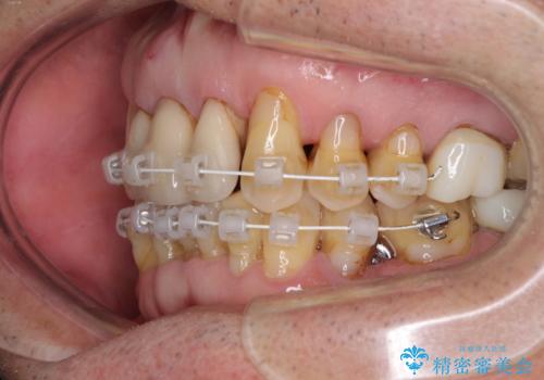 矯正治療と歯周外科処置を併用した審美歯科治療の治療中