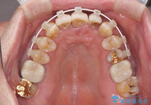 矯正治療と歯周外科処置を併用した審美歯科治療の治療中