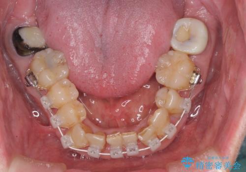 矯正治療と歯周外科処置を併用した審美歯科治療の治療中