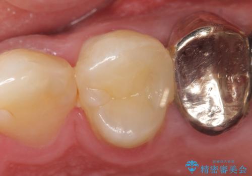 オールセラミッククラウン 歯茎にできた膿の出口(フィステル)の治療の治療前