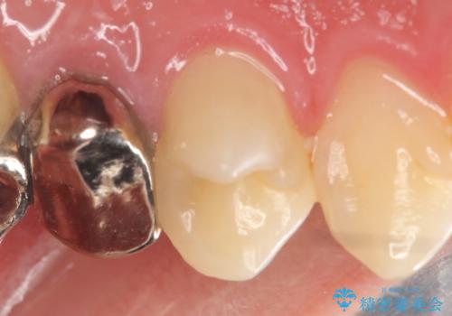 オールセラミッククラウン　歯茎にできた膿の出口(フィステル)の治療の治療前