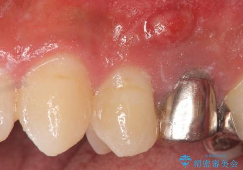 オールセラミッククラウン　歯茎にできた膿の出口(フィステル)の治療の治療前