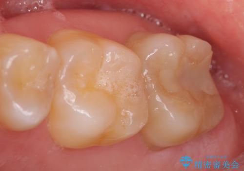 オールセラミッククラウン 痛くて咬めない歯の治療の症例 治療前