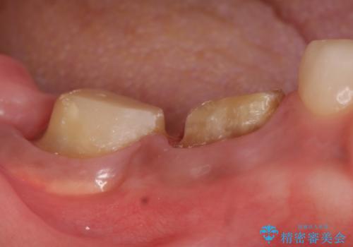 オールセラミッククラウン　欠けてしまった奥歯の治療の治療中