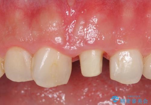 オールセラミッククラウン 長さが気になる前歯の改善の治療中