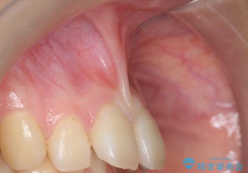 上唇小帯切除 矯正前の予防的処置の治療前