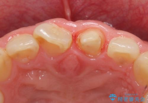 オールセラミッククラウン 長さが気になる前歯の改善の治療中