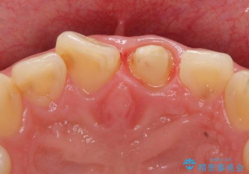 オールセラミッククラウン　長さが気になる前歯の改善の治療中