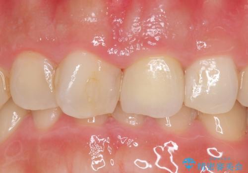 オールセラミッククラウン 長さが気になる前歯の改善の症例 治療後