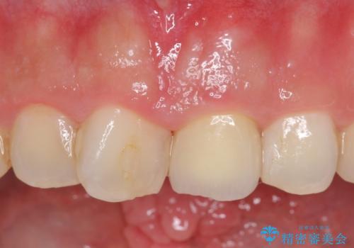 オールセラミッククラウン 長さが気になる前歯の改善の治療後