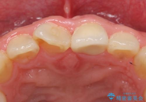 オールセラミッククラウン　長さが気になる前歯の改善の治療後