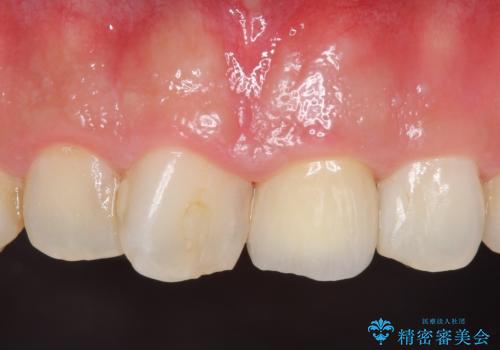 オールセラミッククラウン 長さが気になる前歯の改善の治療後