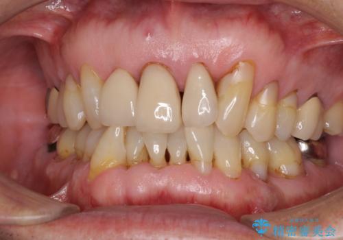 矯正治療と歯周外科処置を併用した審美歯科治療の症例 治療前