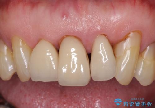 矯正治療と歯周外科処置を併用した審美歯科治療の治療前