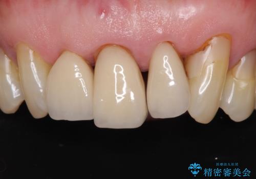 矯正治療と歯周外科処置を併用した審美歯科治療の治療前
