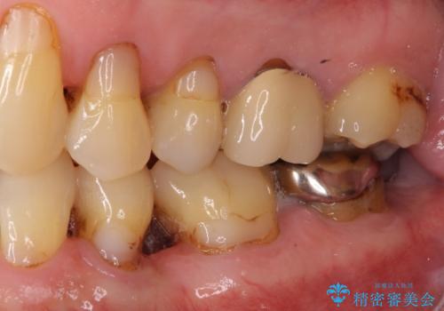矯正治療と歯周外科処置を併用した審美歯科治療の治療前