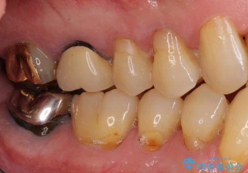 矯正治療と歯周外科処置を併用した審美歯科治療の治療前