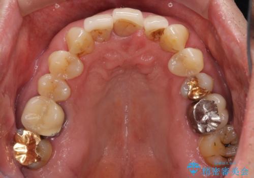 矯正治療と歯周外科処置を併用した審美歯科治療の治療前