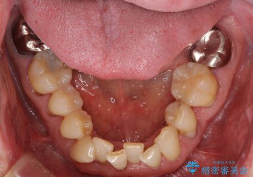 矯正治療と歯周外科処置を併用した審美歯科治療の治療前