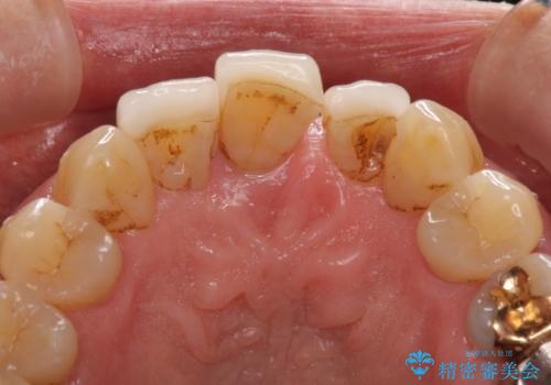矯正治療と歯周外科処置を併用した審美歯科治療の治療前