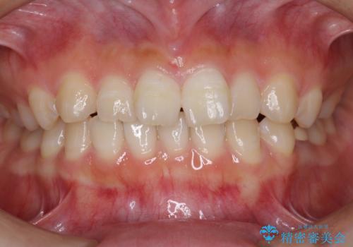 前歯のねじれ 乳歯を残して矯正治療