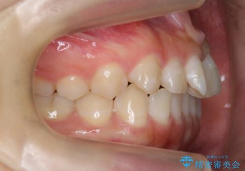前歯のねじれ　乳歯を残して矯正治療の治療前