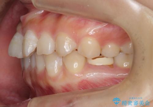 前歯のねじれ　乳歯を残して矯正治療の治療前