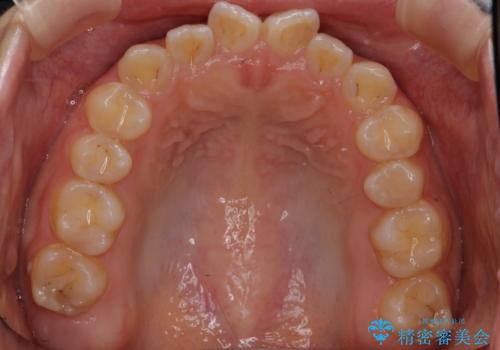 前歯のねじれ 乳歯を残して矯正治療の治療前