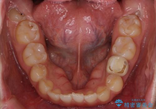 前歯のねじれ 乳歯を残して矯正治療の治療前