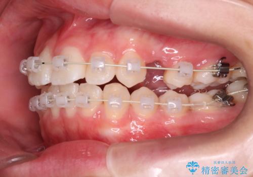 笑顔がきれいになった。抜歯矯正(審美装置)の治療中