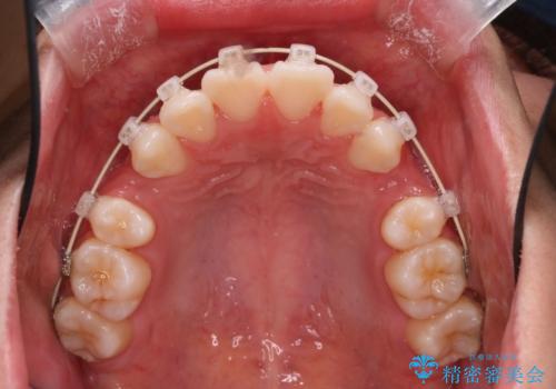 笑顔がきれいになった。抜歯矯正(審美装置)の治療中