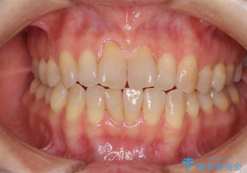 前歯の叢生と切端咬合　インビザラインによる矯正治療の治療前