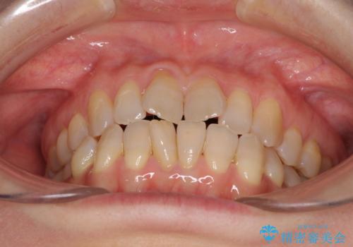 前歯の叢生と切端咬合 インビザラインによる矯正治療の治療前