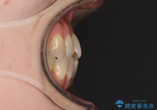 前歯の叢生と切端咬合 インビザラインによる矯正治療の治療前