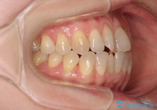 前歯の叢生と切端咬合 インビザラインによる矯正治療の治療前