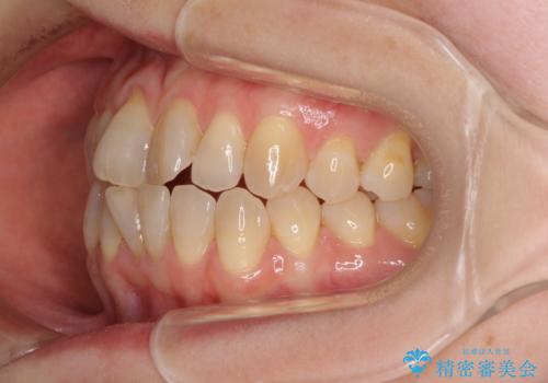 前歯の叢生と切端咬合 インビザラインによる矯正治療の治療前