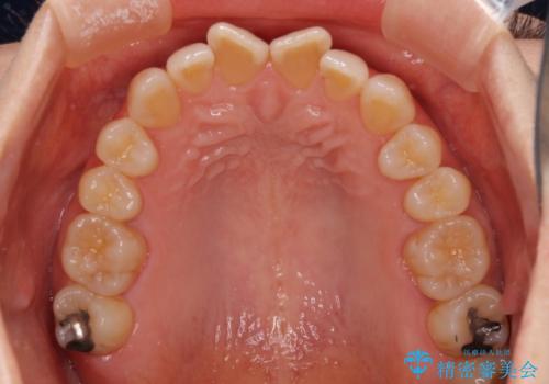 前歯の叢生と切端咬合　インビザラインによる矯正治療の治療前
