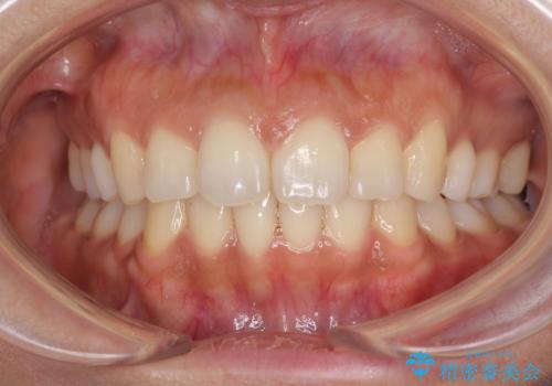 抜歯矯正の後戻り インビザラインによる再矯正治療の治療中