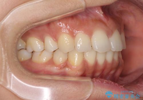 抜歯矯正の後戻り インビザラインによる再矯正治療の治療中