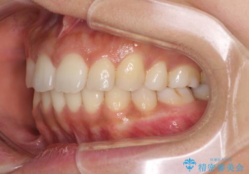 抜歯矯正の後戻り インビザラインによる再矯正治療の治療中