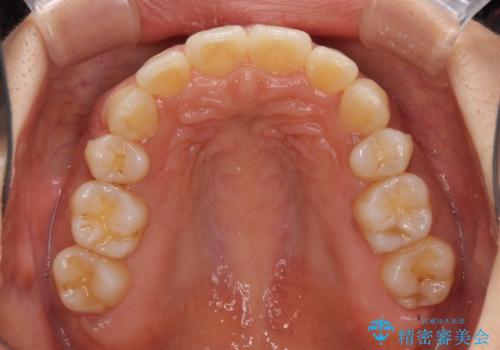抜歯矯正の後戻り インビザラインによる再矯正治療の治療中