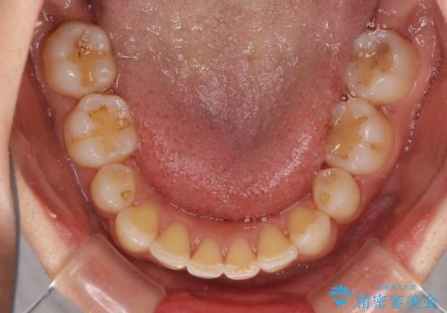 抜歯矯正の後戻り インビザラインによる再矯正治療の治療中