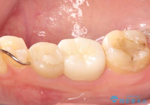 目立つ銀歯を白くしたい セラミック治療の治療後