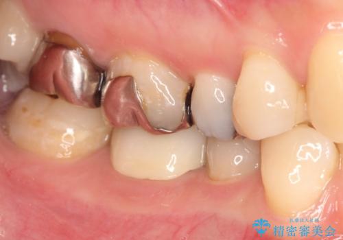 目立つ銀歯を白くしたい セラミック治療の治療後